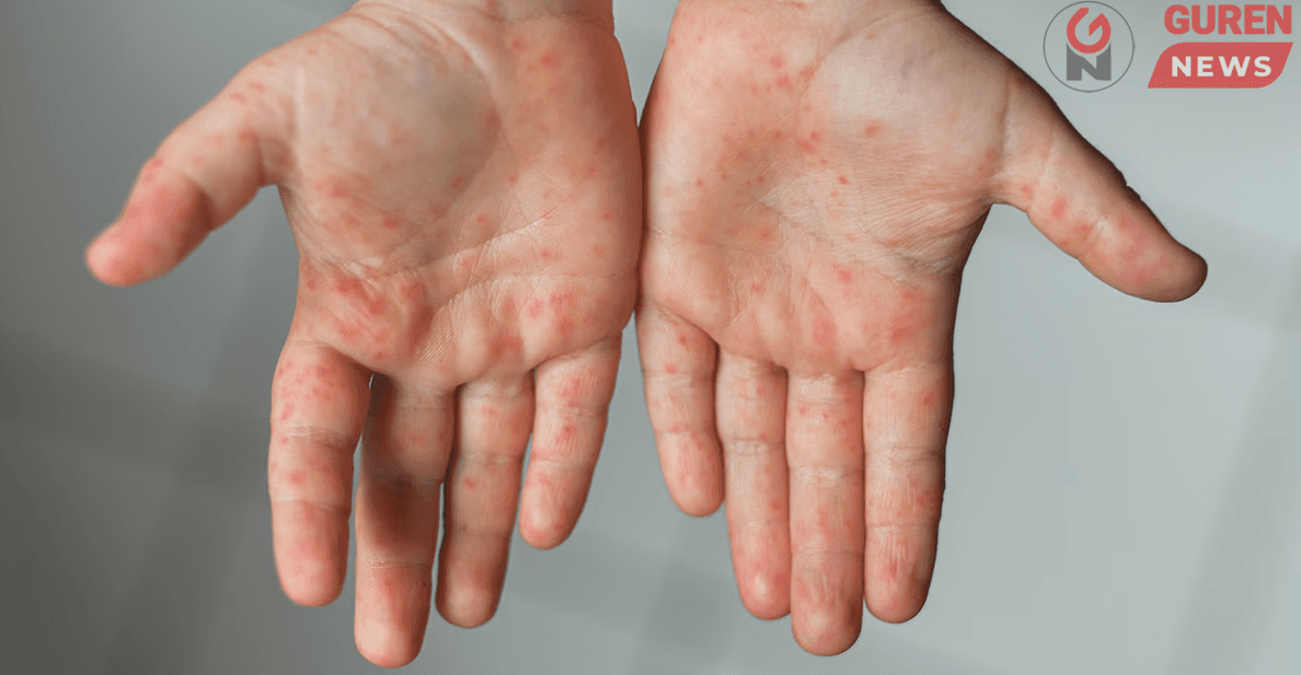 ХӨСҮТ: Улаанбурхан өвчний лабораториор батлагдсан тохиолдол 11016 болжээ